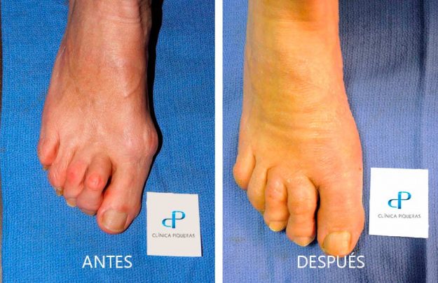 anters-despues-tratamiento-juanetes-dedos-en-garra-piqueras