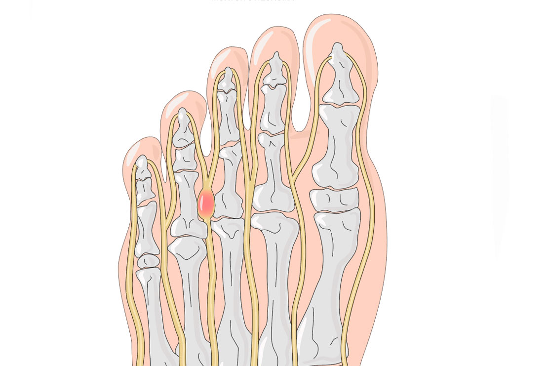 Tratamiento del Neuroma de Morton