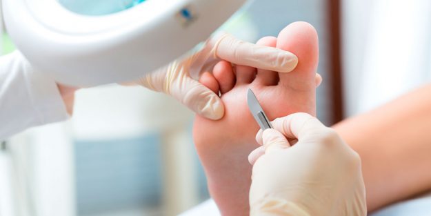 Eliminar los callos en los pies