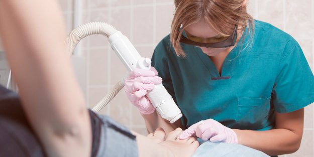 Tratamiento de láser para los hongos en las uñas