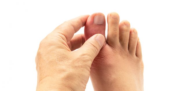 Exostosis Subungueal